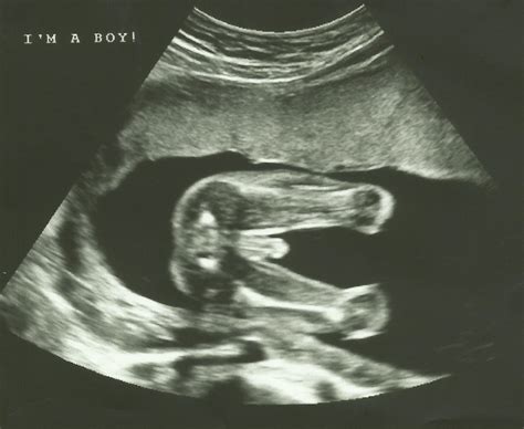 20 Week Ultrasound (Anatomy Scan): What to Expect.